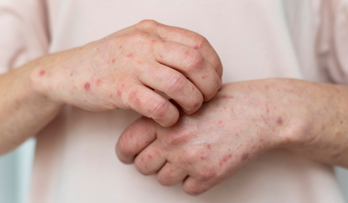 Urticaria, causas y tratamientos